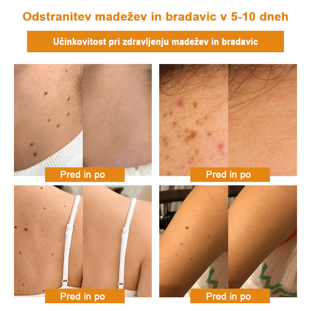 🍯👑𝐁𝐄𝐍𝐄𝐓𝐔𝐑𝐄™ Čebelji strup za odstranjevanje bradavic in madežev (razprodaja zadnjega dne, 80 % popust)