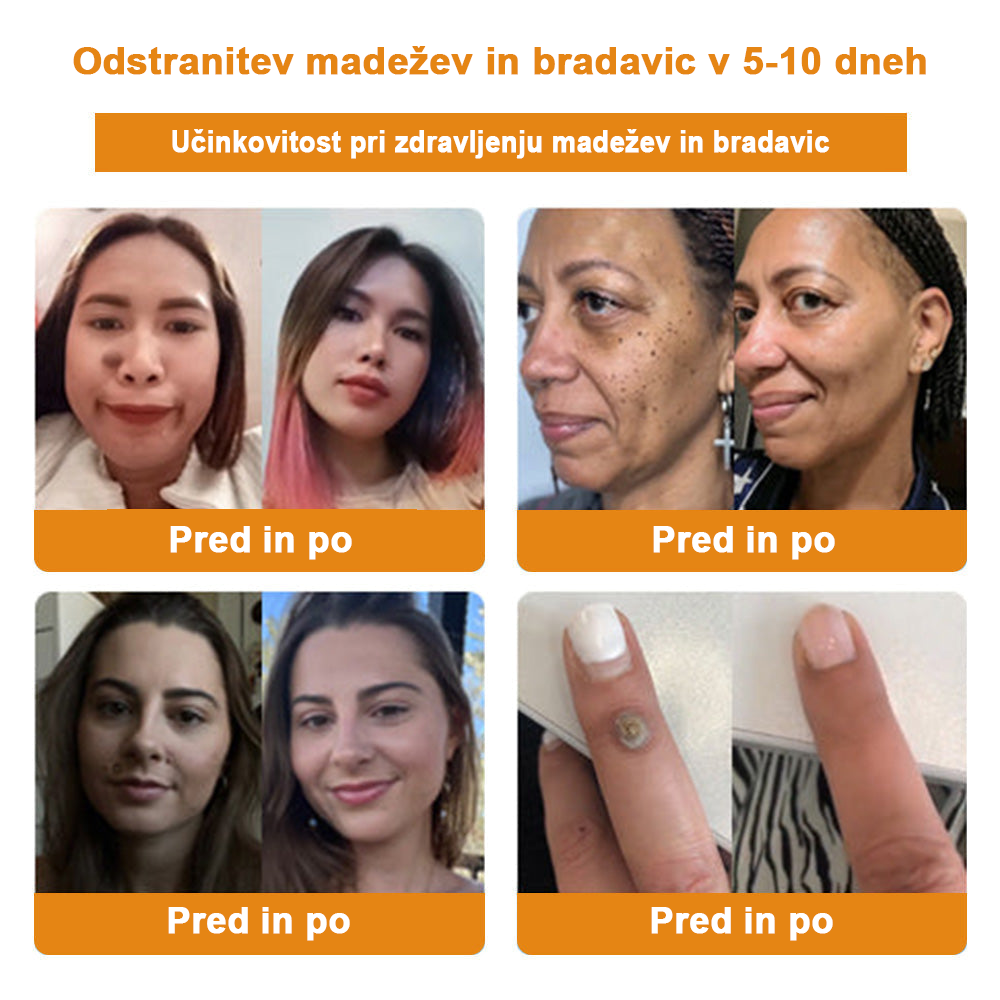 🍯👑𝐁𝐄𝐍𝐄𝐓𝐔𝐑𝐄™ Čebelji strup za odstranjevanje bradavic in madežev (razprodaja zadnjega dne, 80 % popust)