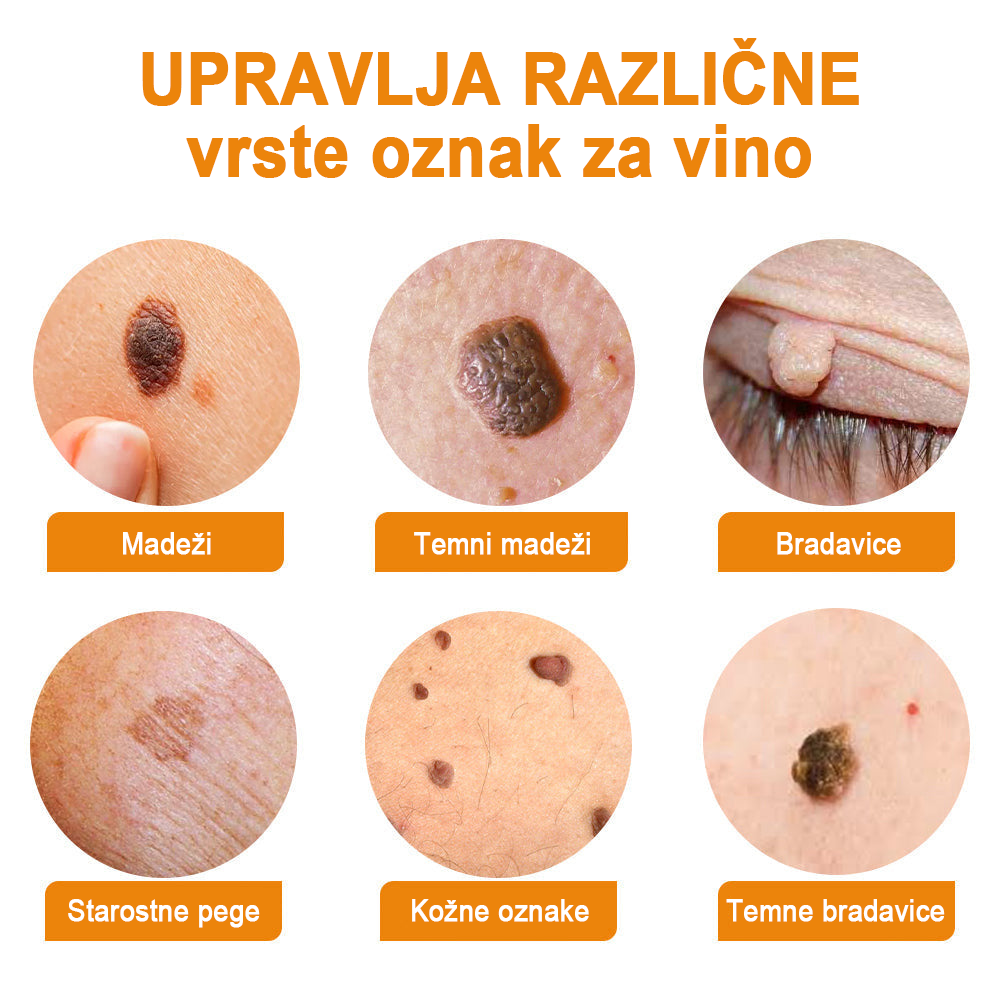 🍯👑𝐁𝐄𝐍𝐄𝐓𝐔𝐑𝐄™ Čebelji strup za odstranjevanje bradavic in madežev (razprodaja zadnjega dne, 80 % popust)